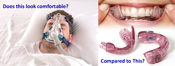 cpap-mascomparedtooralappliance